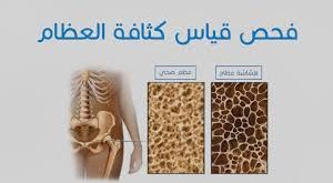 قياس كثافة العظام
